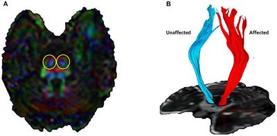 Elucidating the mechanisms of post-stroke motor recovery mediated by electroacupuncture using diffusion tensor tractography